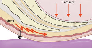 What Is a Pressure Injury? A Caregiver’s Guide to the Basics - Part 1