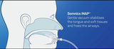 iNAP® Sleep Therapy System - A Proven Solution for Mild, Moderate, or Severe OSA